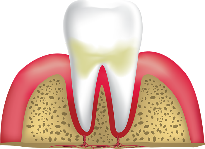 gingivitis Lafayette IN